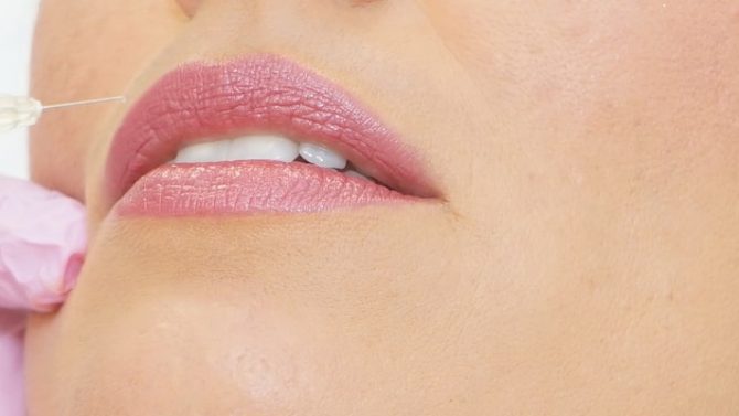 Zum Lippen Aufspritzen wird bei Dermamelius in Siegen einer Kundin Hyaluronsäure für mehr Lippenvolumen und klarere Lippenkonturen injiziert.