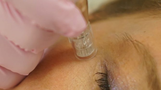 Ein tiefes Needling zur Hautverjüngung wird von einer professionellen medizinischen Kosmetikerin an eine Kundin von Dermamelius in Siegen durchgeführt. 