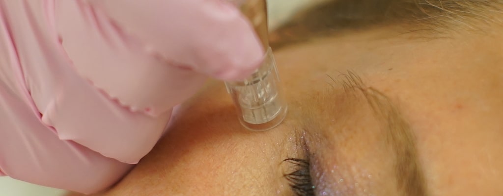 Ein tiefes Needling zur Hautverjüngung wird von einer professionellen medizinischen Kosmetikerin an eine Kundin von Dermamelius in Siegen durchgeführt. 