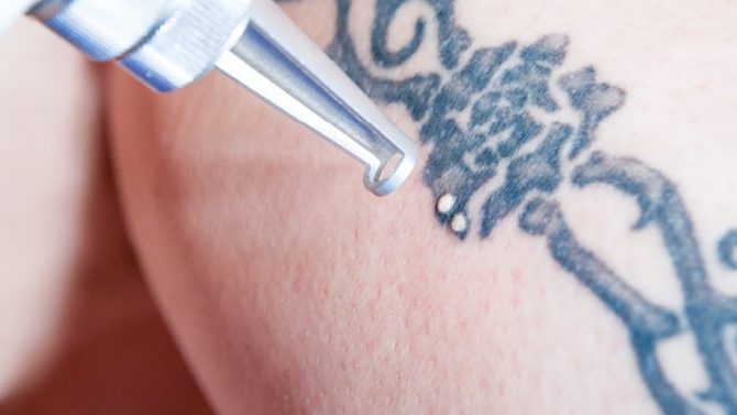 Mit dem Laser wird eine Tattooentfernung am Oberarm eines Kunden von Dermamelius in Siegen durchgeführt.